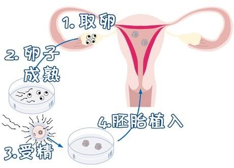 有偿同志供卵代孕怎么预约